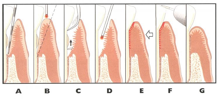 Illustration of 7 different stages of LANAP procedure