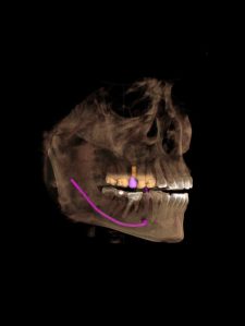 Digital x-ray of upper and lower jaws showing details for bite correction