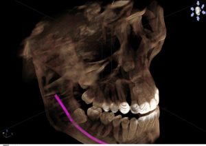 Digital x-ray of upper and lower jaws, upper teeth highlighted