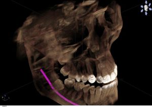 Digital x-ray of upper and lower jaws, upper teeth highlighted