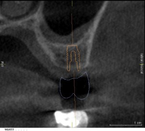 Digital x-ray of a dental implant placed in the jaw