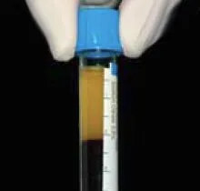Test tube containing PRGF