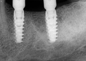 Digital radiography of two dental implants- digital radiography exposes patients to much less radiation