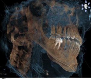 Digital x-ray of upper and lower jaws, lower tooth highlighted