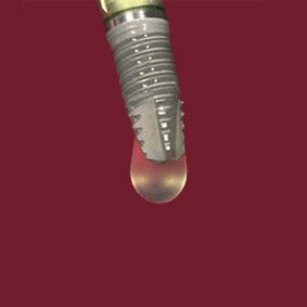 PRGF therapy technique