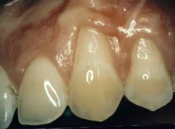 Up close image of a Patient's teeth and gums with gum line recession
