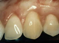 Patient's teeth and gums with a corrected gum line after gum grafting